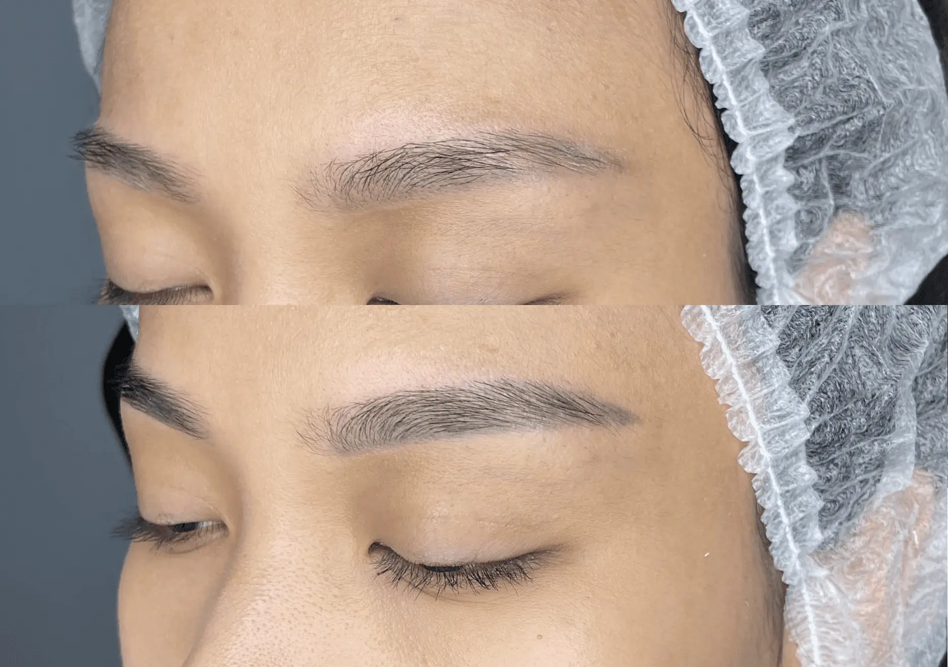 saline tattoo removal